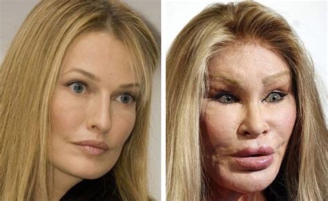 jocelyn wildenstein before and after.